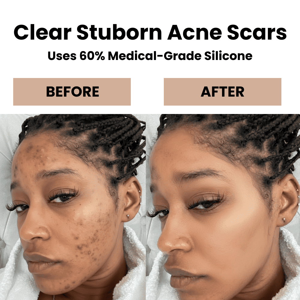 Aurabloom Silicone Scar Stick